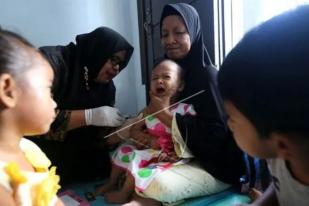 Dinkes Aceh Catat 1.100 kasus Campak Anak