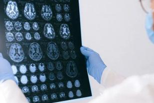 Epilepsi dapat Mengganggu Perkembangan Otak Motorik Anak