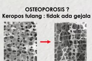 Osteoporosis dapat Dicegah Sejak Anak-anak