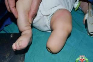 Serangan Kimia di Suriah Akibatkan Cacat Lahir Pada Bayi