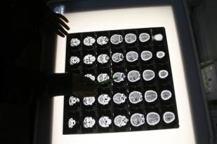 Studi Baru Dapat Ubah Perawatan Sejenis Kanker Otak