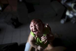 Brasil Konfirmasi 641 Kasus Microcephaly