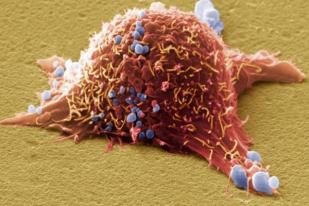 Virus Herpes Berpotensi Sembuhkan Kanker Kulit